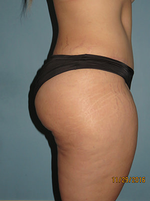 Tummy Tuck