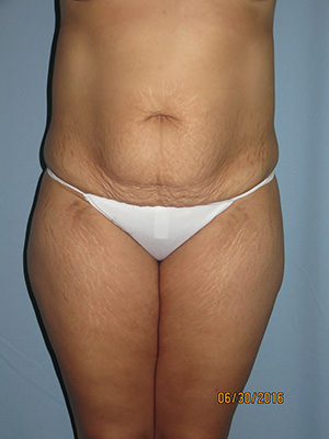 Tummy Tuck