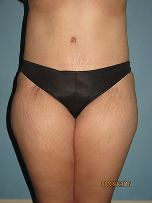 Tummy Tuck