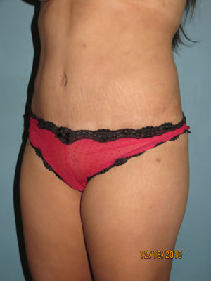 Tummy Tuck