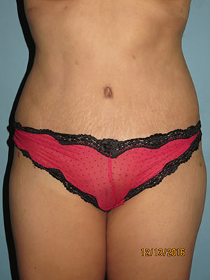 Tummy Tuck