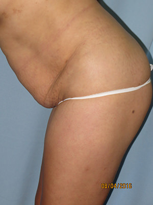 Tummy Tuck