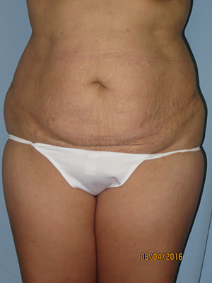 Tummy Tuck