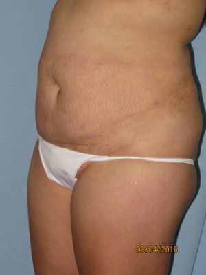 Tummy Tuck