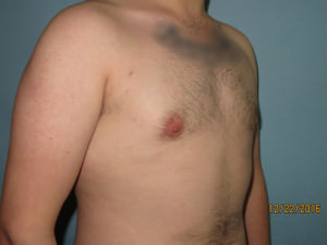 Male Breast Reduction - Gynecomastia