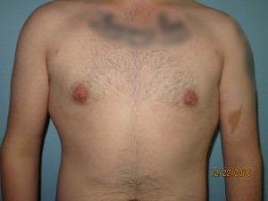 Male Breast Reduction - Gynecomastia