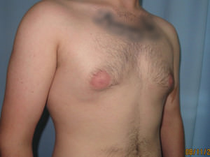 Male Breast Reduction - Gynecomastia