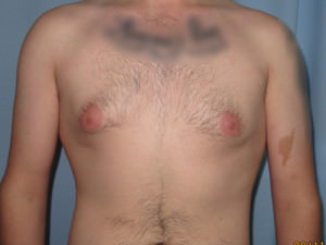 Male Breast Reduction - Gynecomastia