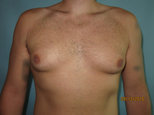 Male Breast Reduction - Gynecomastia