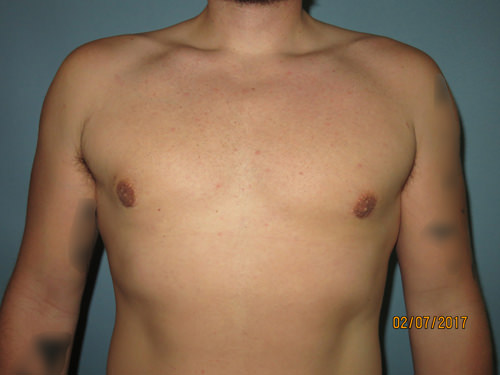 Male Breast Reduction - Gynecomastia