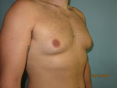 Male Breast Reduction - Gynecomastia