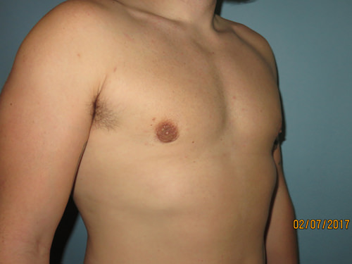 Male Breast Reduction - Gynecomastia