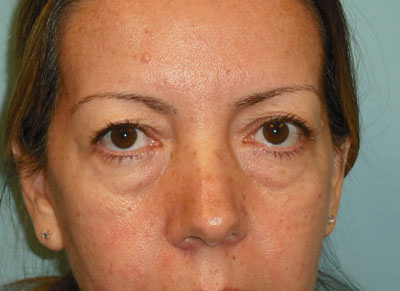 Blepharoplasty