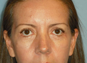 Blepharoplasty