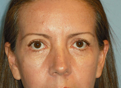 Blepharoplasty
