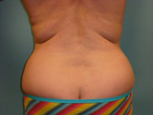 Liposuction