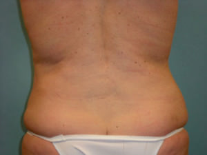 Liposuction