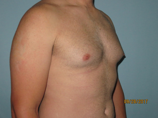 Male Breast Reduction - Gynecomastia