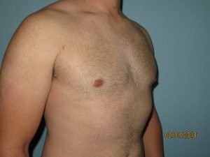 Male Breast Reduction - Gynecomastia