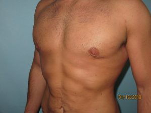 Male Breast Reduction - Gynecomastia