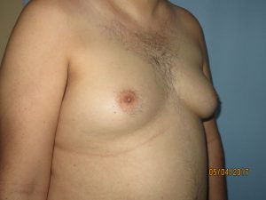 Male Breast Reduction - Gynecomastia