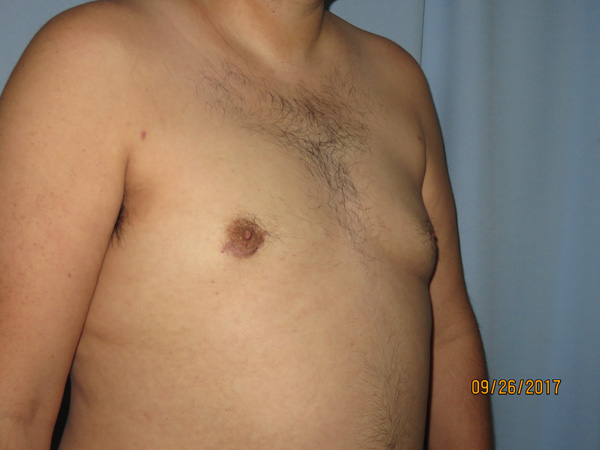 Male Breast Reduction - Gynecomastia