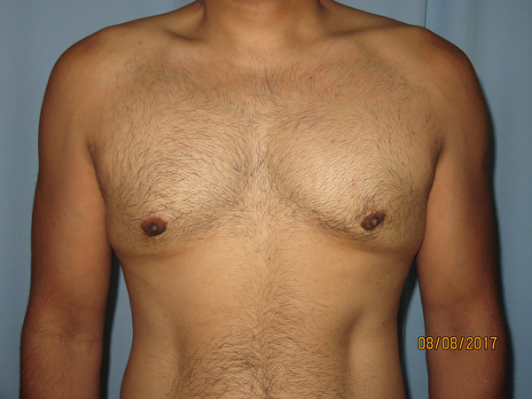 Male Breast Reduction - Gynecomastia