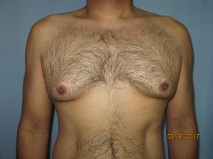 Male Breast Reduction - Gynecomastia