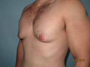 Male Breast Reduction - Gynecomastia