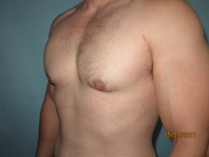 Male Breast Reduction - Gynecomastia