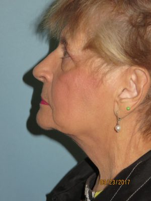 Neck Lift