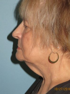 Facelift