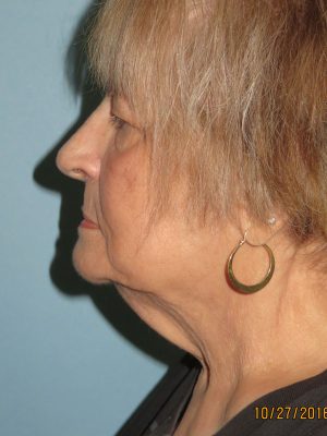 Neck Lift