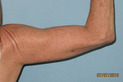 after arm lift surgery photo Scottsdale, AZ