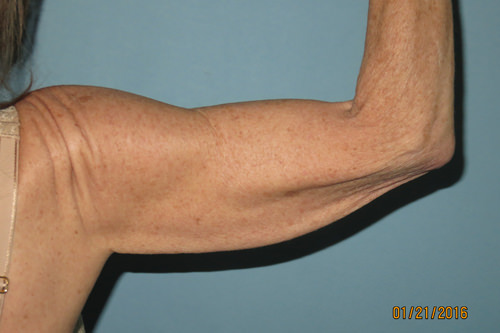 before arm lift surgery photo Scottsdale, AZ