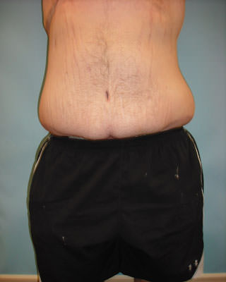 lower body lift after surgery Scottsdale, AZ 