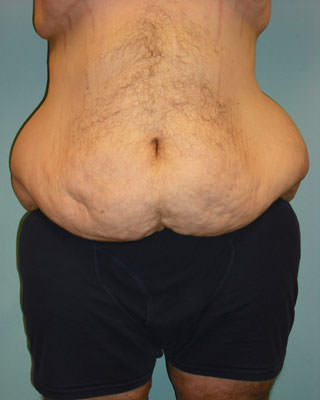 lower body lift before surgery Scottsdale, AZ