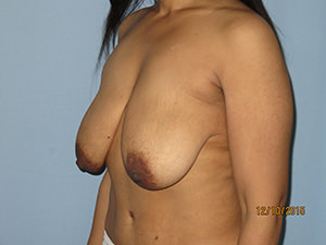 Breast Reduction Before