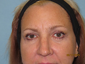 Blepharoplasty (Eyelid Lift) After