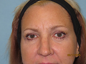 After Image of Cosmetic Eyelid Surgery Scottsdale