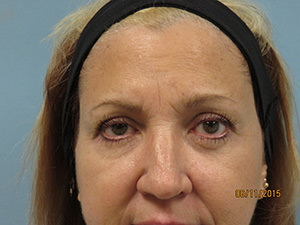 Before Image of Cosmetic Eyelid Surgery Scottsdale
