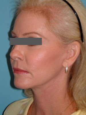 Facial Fat Grafting After