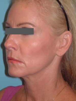 Facial Fat Grafting Before