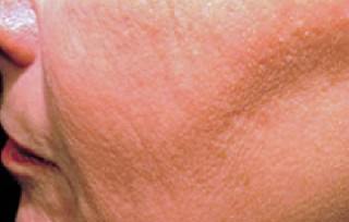 Skin Resurfacing After
