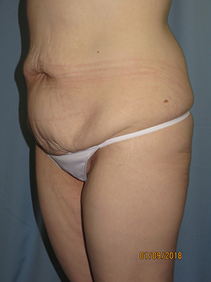 Tummy Tuck