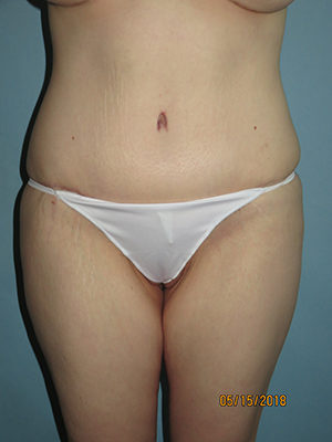 Tummy Tuck