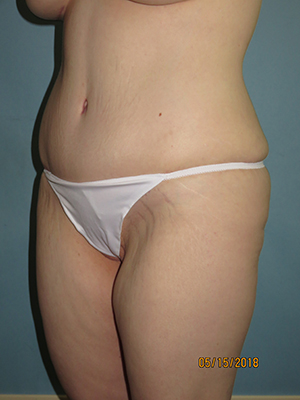 Tummy Tuck