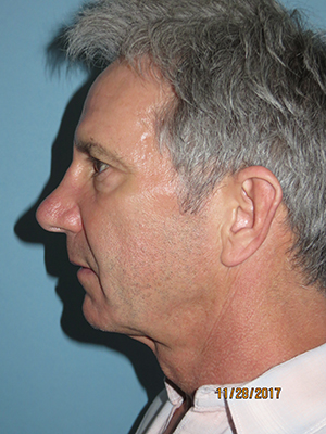 Neck Lift: Men