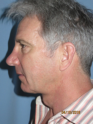 Neck Lift: Men
