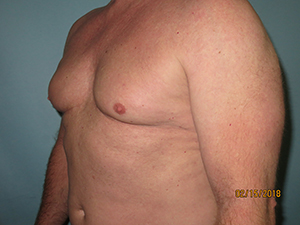 Male Breast Reduction - Gynecomastia